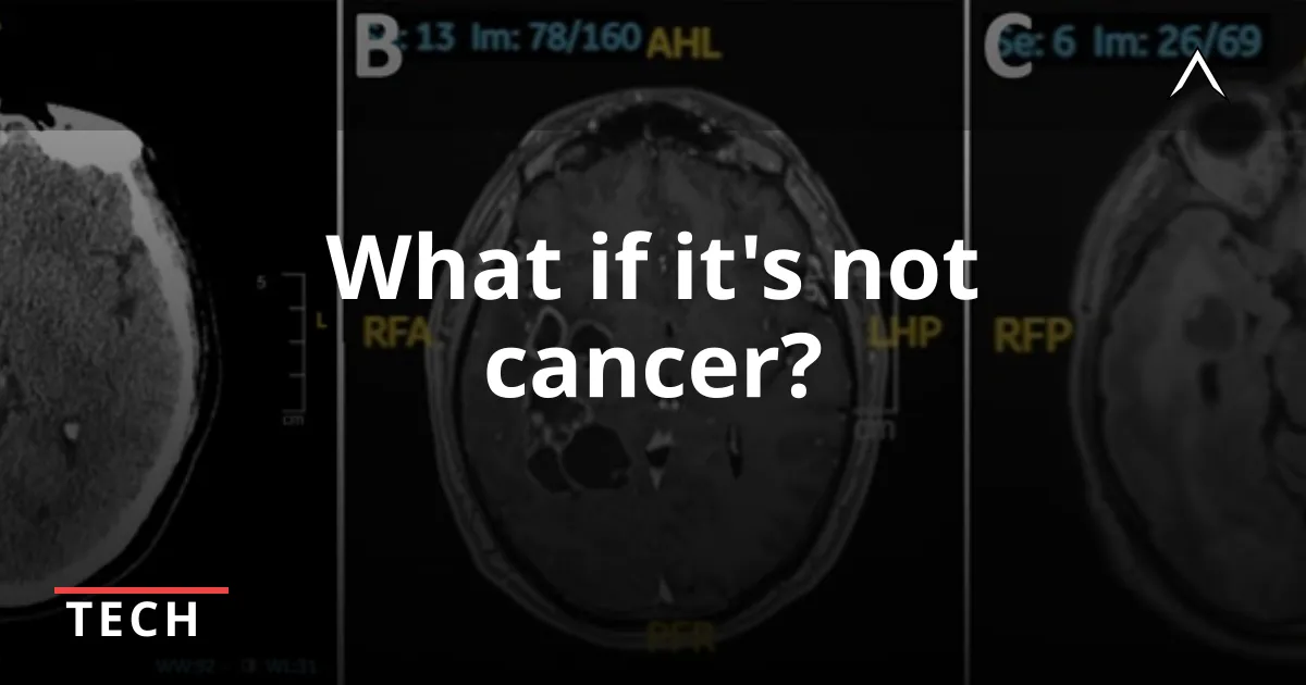 Doctors Mistake Tapeworms for Brain Cancer